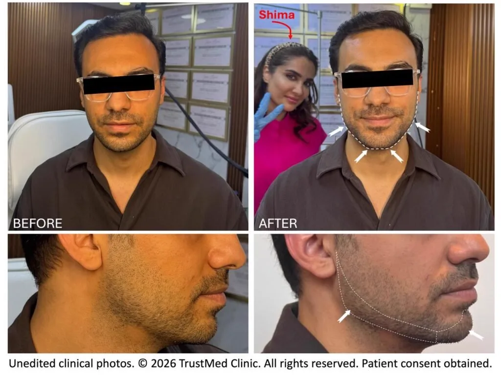Natural jawline and chin definition